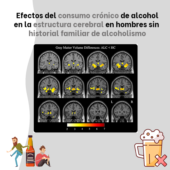 Efectos del consumo crónico de alcohol en la estructura cerebral