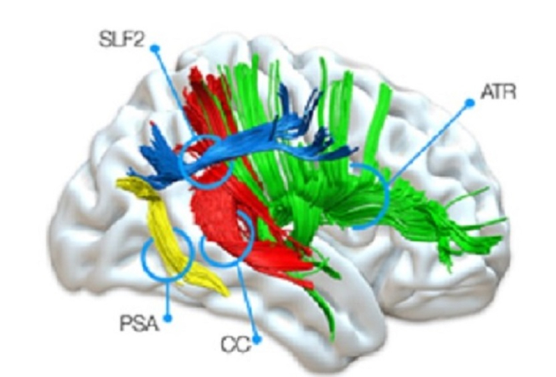 Imagen del cerebro mediante resonancia magnética. Fibras cerebrales mas activas en la experiencia visual consciente