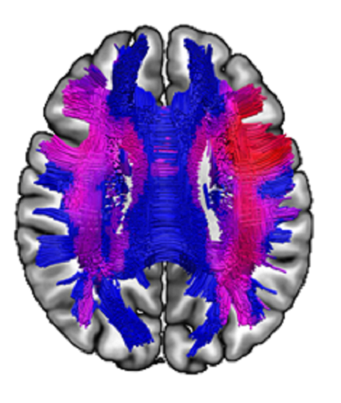Imagen del cerebro por resonancia magnética Participación sustancia blanca en las capacidades funcionales